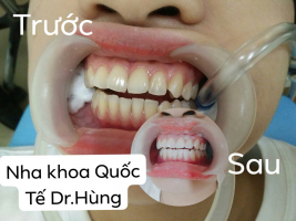 Top 3 Địa chỉ tẩy trắng răng uy tín nhất Cà Mau