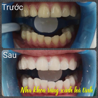 Top 4 Địa chỉ tẩy trắng răng uy tín nhất Hà Tĩnh