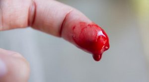 Top 7 Cách cầm máu tại nhà với vết thương nhẹ hiệu quả nhất